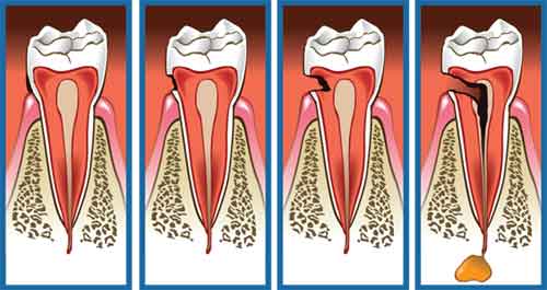 a fogszuvasodás okoz-e fogyást