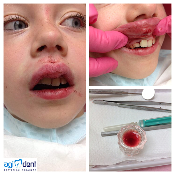 kitört metszőfog gyerek