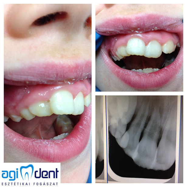 Fog baleset után egy hónappal